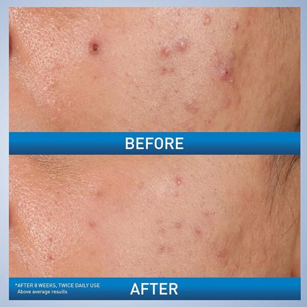 21% deal on CeraVe Acne Control Gel, 2% Salicylic Acid Treatment With Glycolic Acid + Lactic Acids + Niacniamide - Image 4